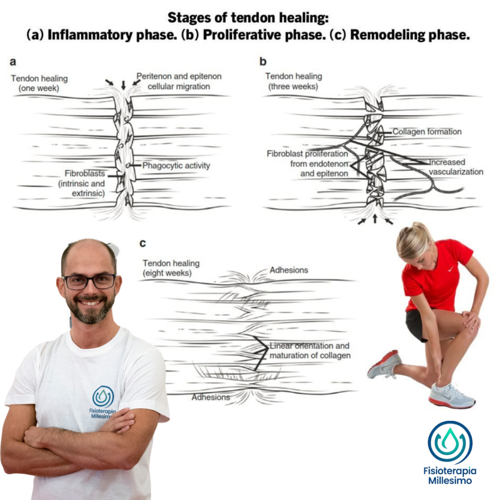 fasi della guarigione tendinea. Fisioterapia tendine